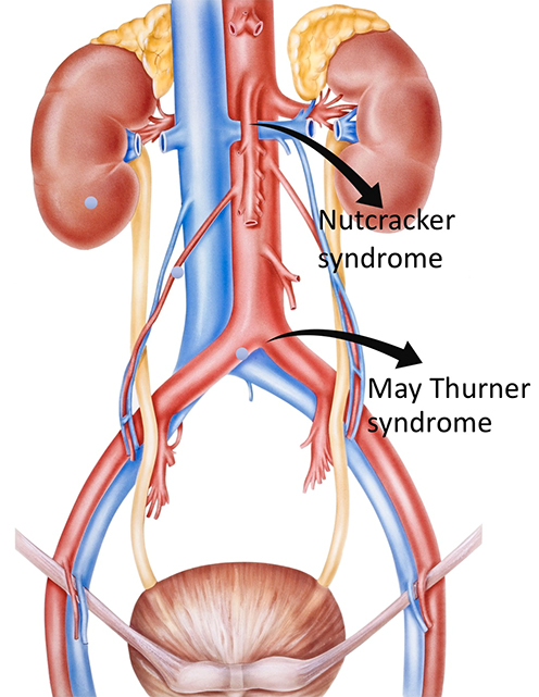 nutcracker syndrome causes