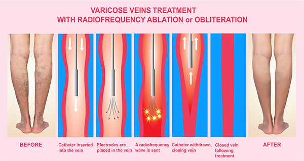 Glue Treatment For Varicose Veins