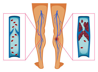 deep vein thrombosis vs varicose veins